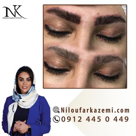 ریموو تاتو ابرو در مرکز ریموو تاتو نیلوفر کاظمی