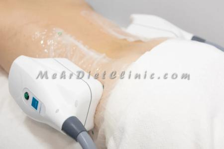 دستگاه لاغری رافوس آر اف RF در بلوار مرزداران
