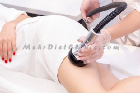 لاغری موضعی با دستگاه ال پی جی