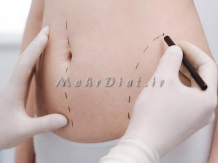 دستگاه لاغری تری پولار آر افTripollar RF