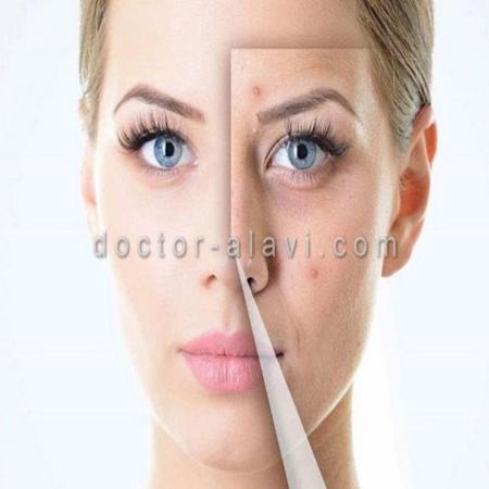 پاکسازی و رفع جوش زیرپوستی